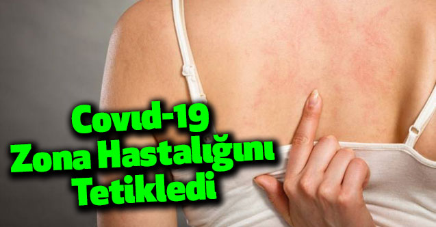 Covıd-19 Zona Hastalığını Tetikledi