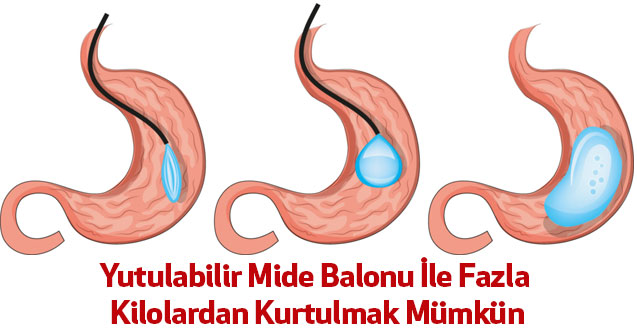 Yutulabilir Mide Balonu İle Fazla Kilolardan Kurtulmak Mümkün