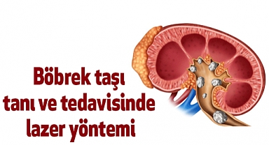 Böbrek taşı tanı ve tedavisinde lazer yöntemi