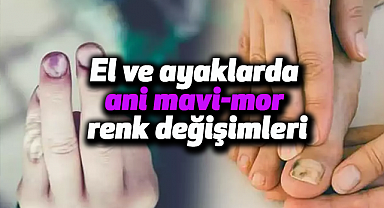 El ve ayaklarda ani mavi-mor renk değişimleri