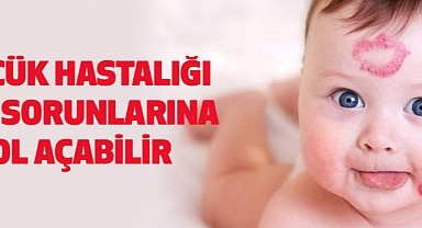 Öpücük hastalığı ciddi sorunlarına yol açabilir