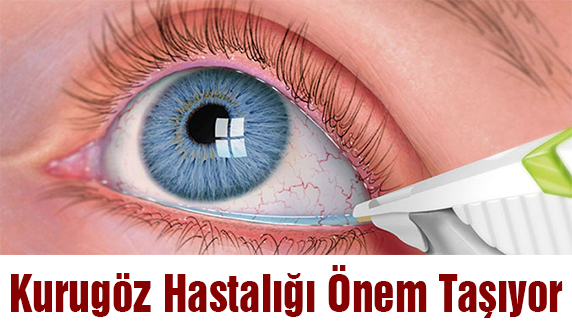 Kurugöz Hastalığı Önem Taşıyor