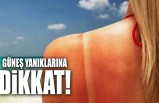 Güneş Yanıklarına Dikkat