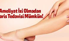 Ameliyat İzi Olmadan Varis Tedavisi Mümkün!
