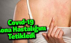 Covıd-19 Zona Hastalığını Tetikledi