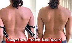 Skolyoz Nedir, Tedavisi Nasıl Yapılır?