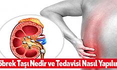 Böbrek Taşı Nedir ve Tedavisi Nasıl Yapılır?